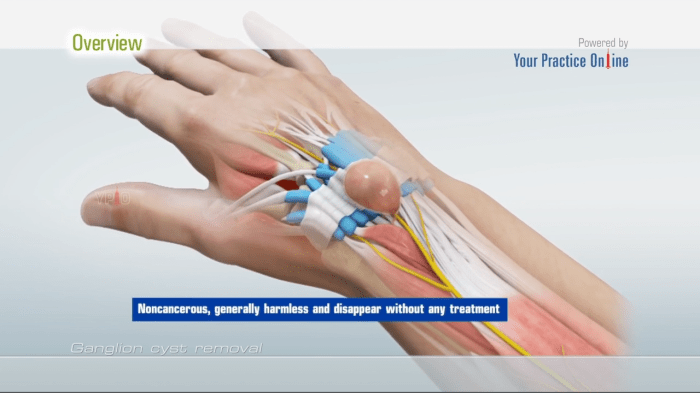 Ganglion cyst drains