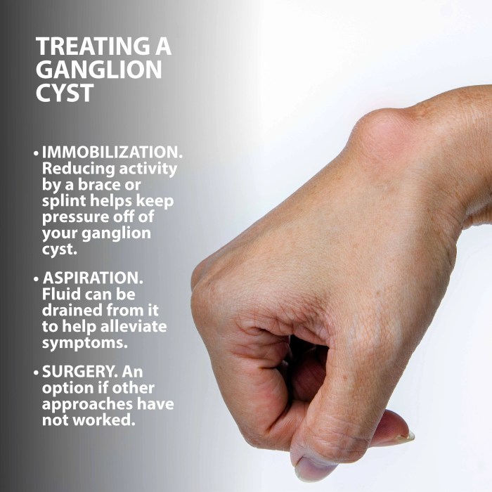 Ganglion cyst removal cpt code