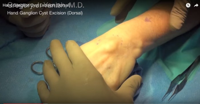 Ganglion cyst removal cpt code